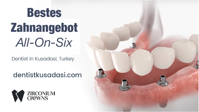 Bestes Dentalangebot – All On Six Zahnimplantate