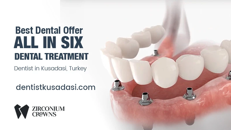 Best Dental Offer - All On Six