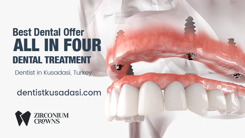 Best Dental Offer - All on Four