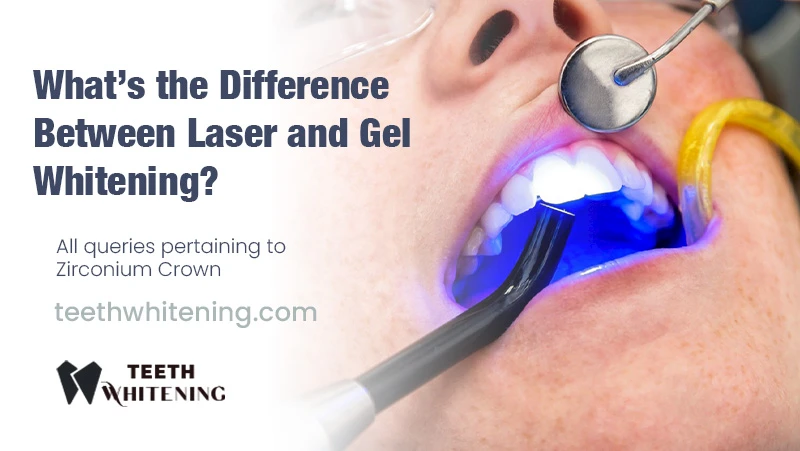 What’s the Difference Between Laser and Gel Whitening?