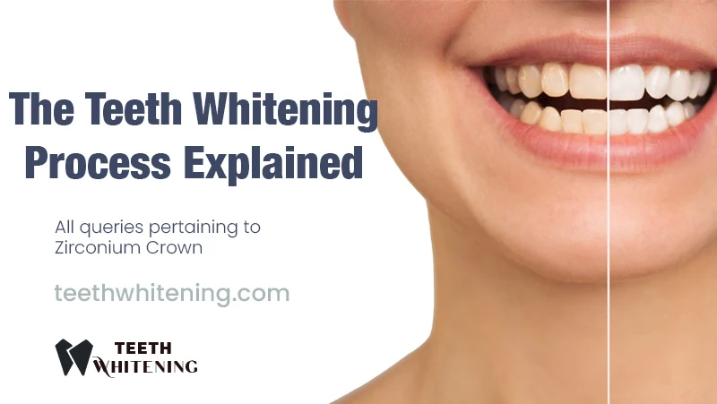 The Teeth Whitening Process Explained