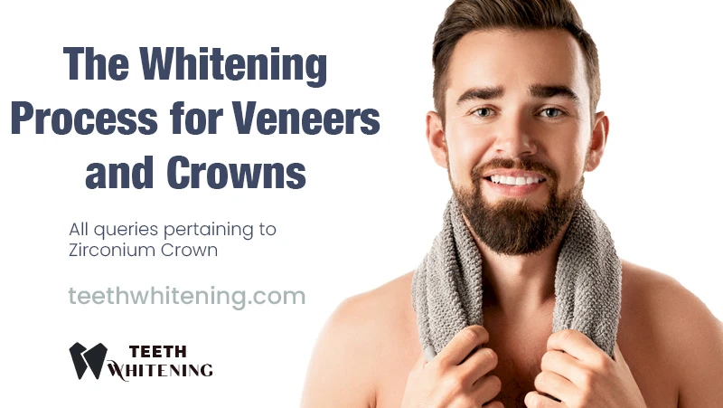 The Whitening Process for Veneers and Crowns